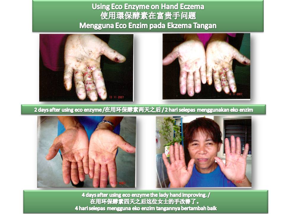 Butterworth Lady Eczema Hand picture